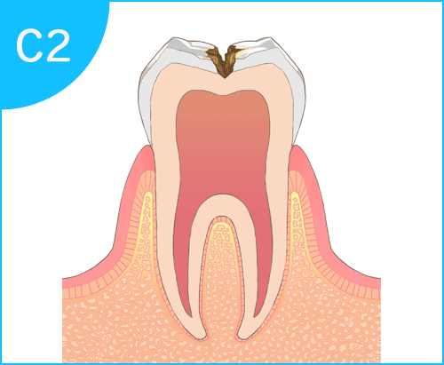 むし歯の進行過程