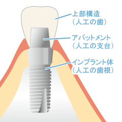 インプラントの構造