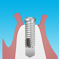 インプラント手術