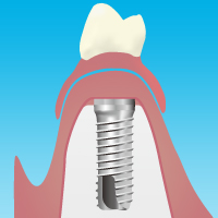 インプラント手術