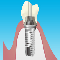 インプラント手術